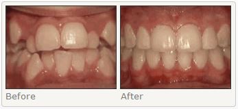 Crowding of the Teeth Before