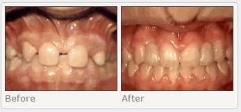 Missing lateral incisors