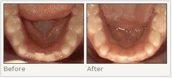 Non-braces treatment